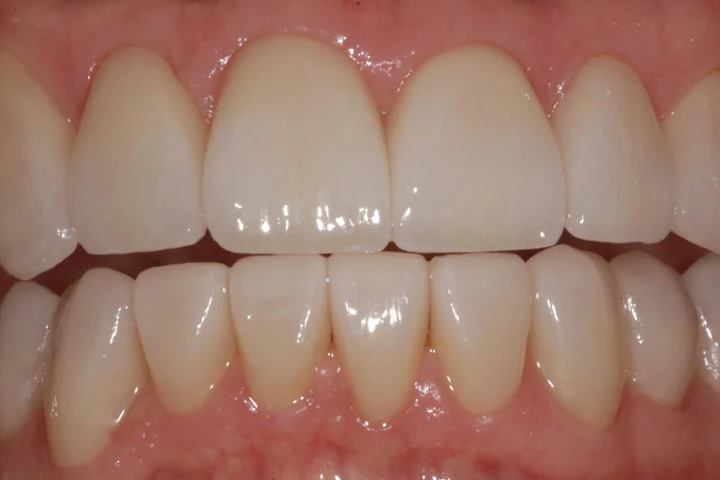 Dental Implant — after treatment