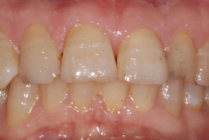 Dental Implant — before treatment