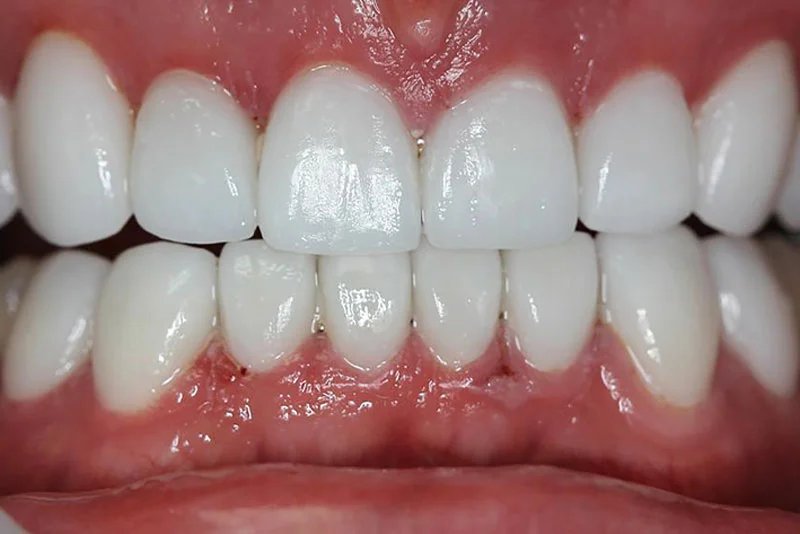 Dental Implant — after treatment