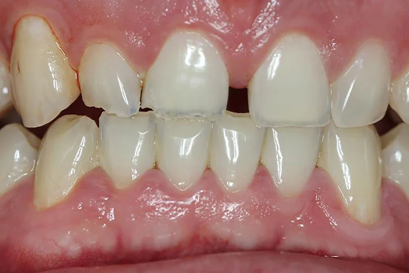 Dental Implant — before treatment