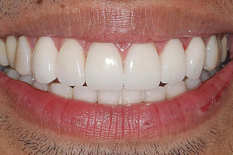 Dental Implant — after treatment