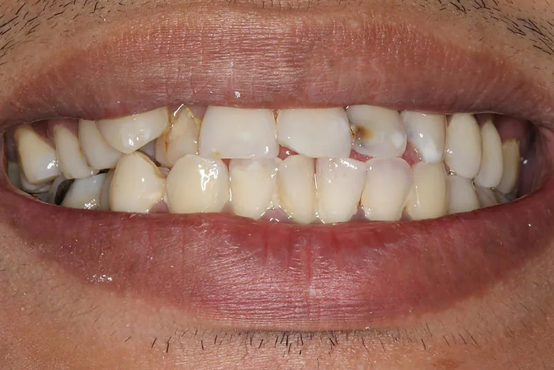 Dental Implant — before treatment