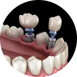 Dental implant illustration