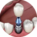 Dental model showing tooth structure