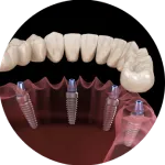 Full arch dental implant model