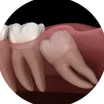 Wisdom Teeth Removal
