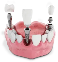 Dental Implants